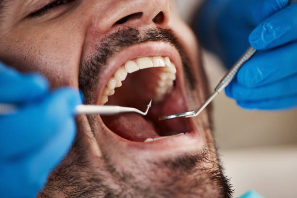 Best Emergency Wisdom Teeth Removal in Cressona, PA