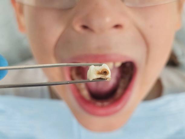 Best Emergency Tooth Extraction in Cressona, PA