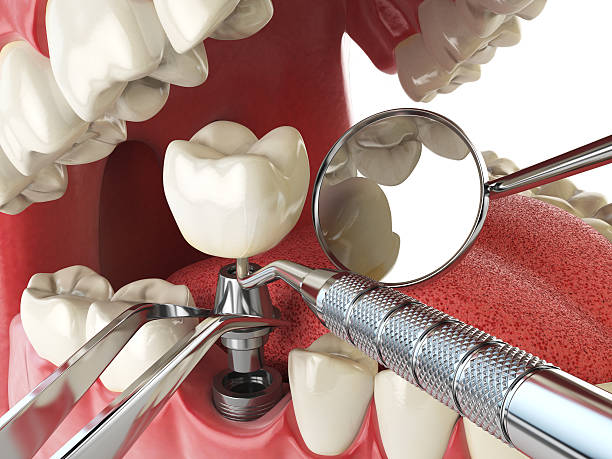 Best Emergency Treatment for Dental Infections or Abscesses in Cressona, PA
